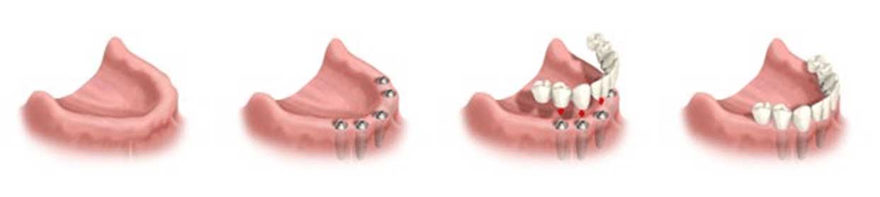 all-on-4-dental-implants-dr-ghayoumi-irvine
