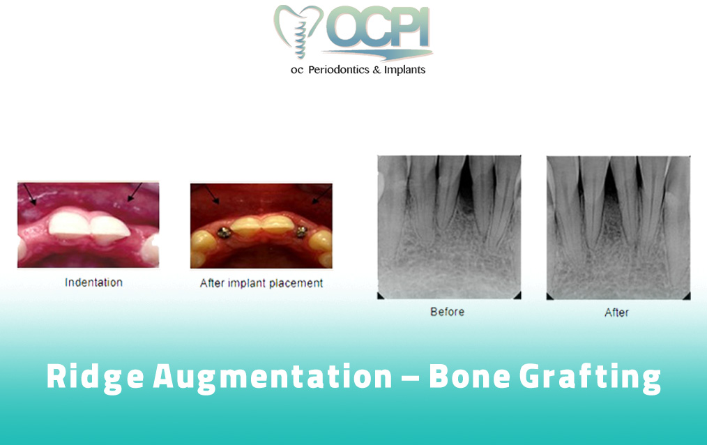 Ridge Augmentation Bone Grafting In Orange County