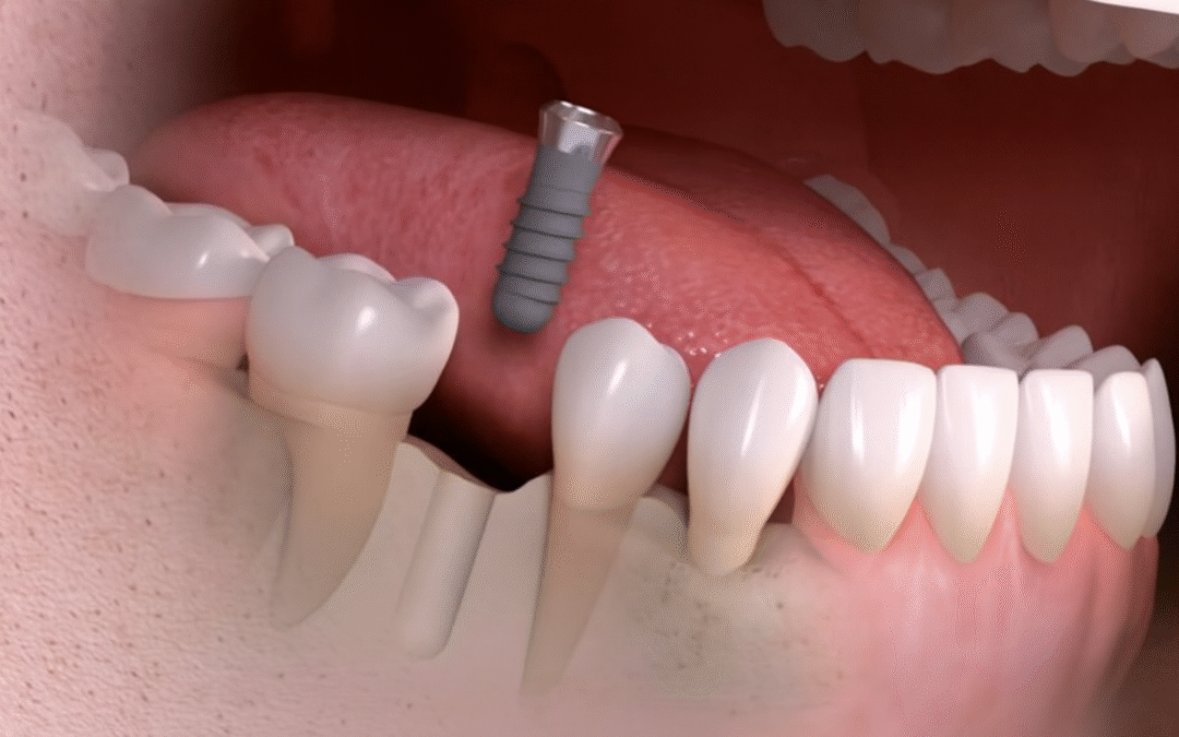 Understanding Dental Implant Pain After Surgery