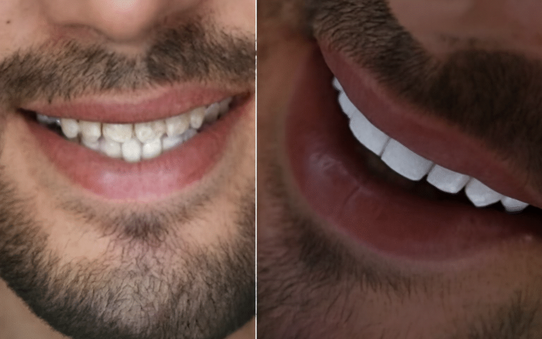 What is a Smile Makeover