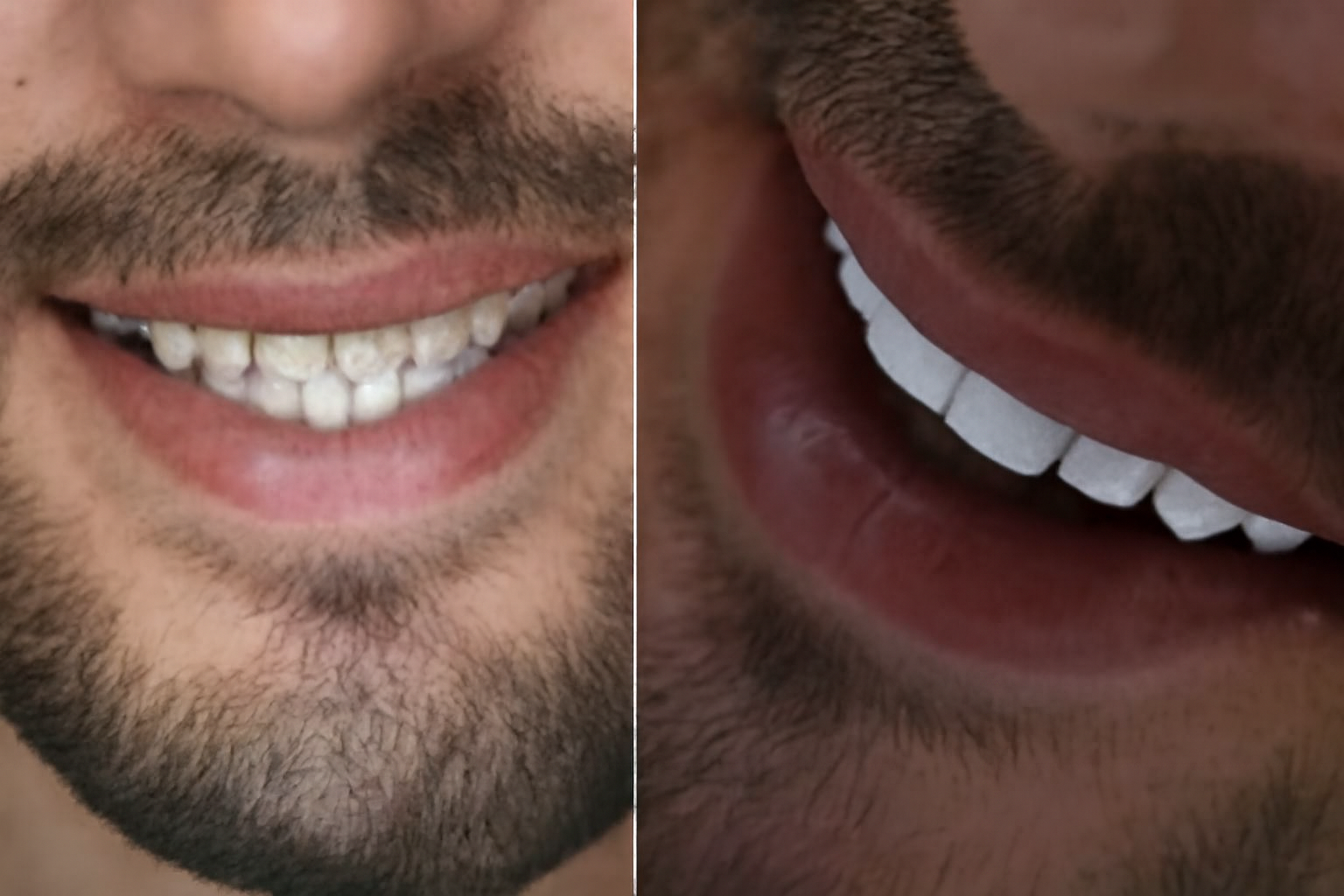 What is a Smile Makeover