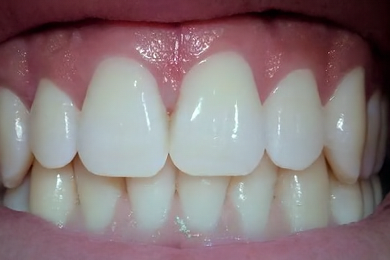 Surfaces of the Teeth