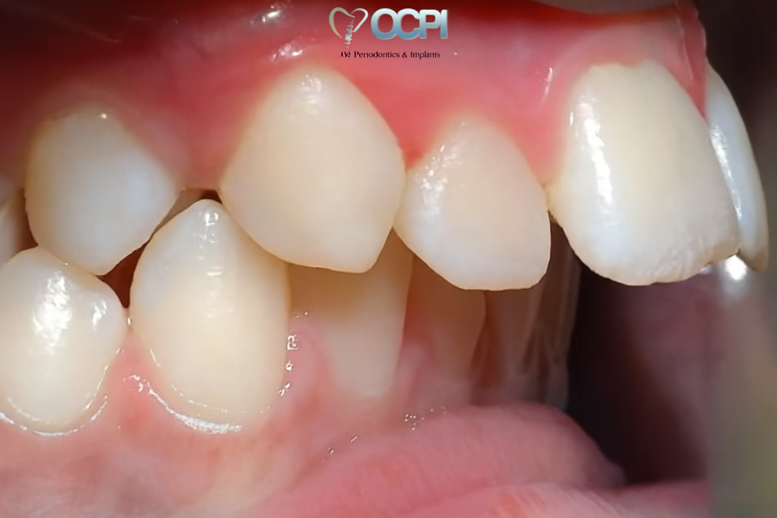 What is a Overbite ?