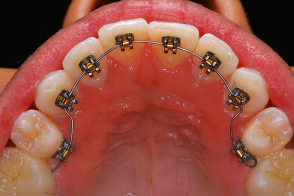 Lingual Orthodontics