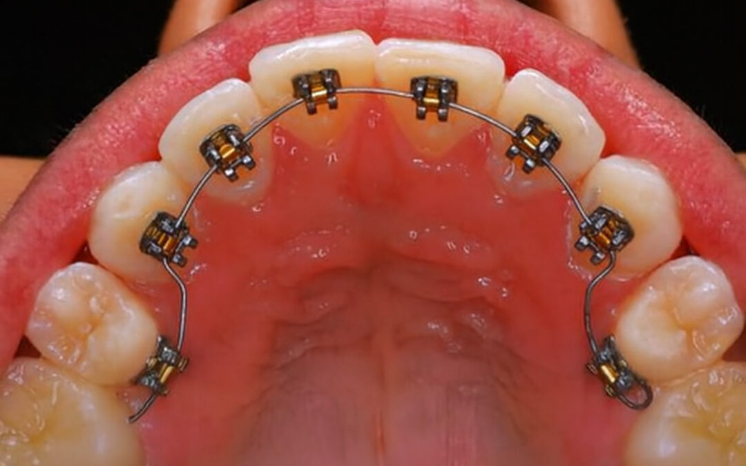 Lingual Orthodontics