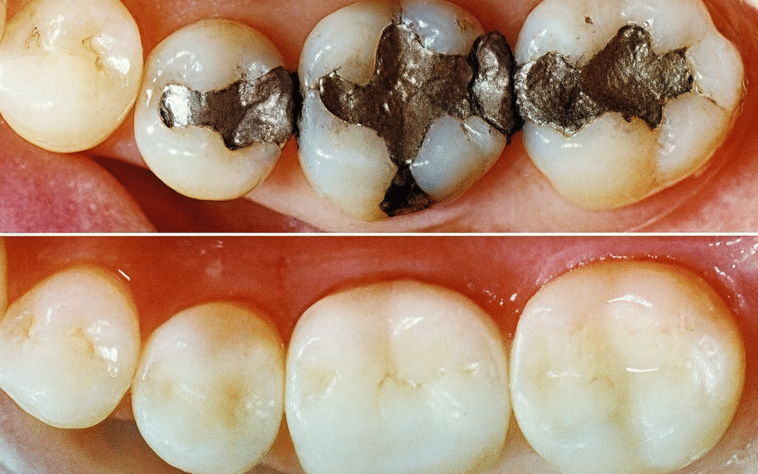Amalgam vs. Composite Fillings
