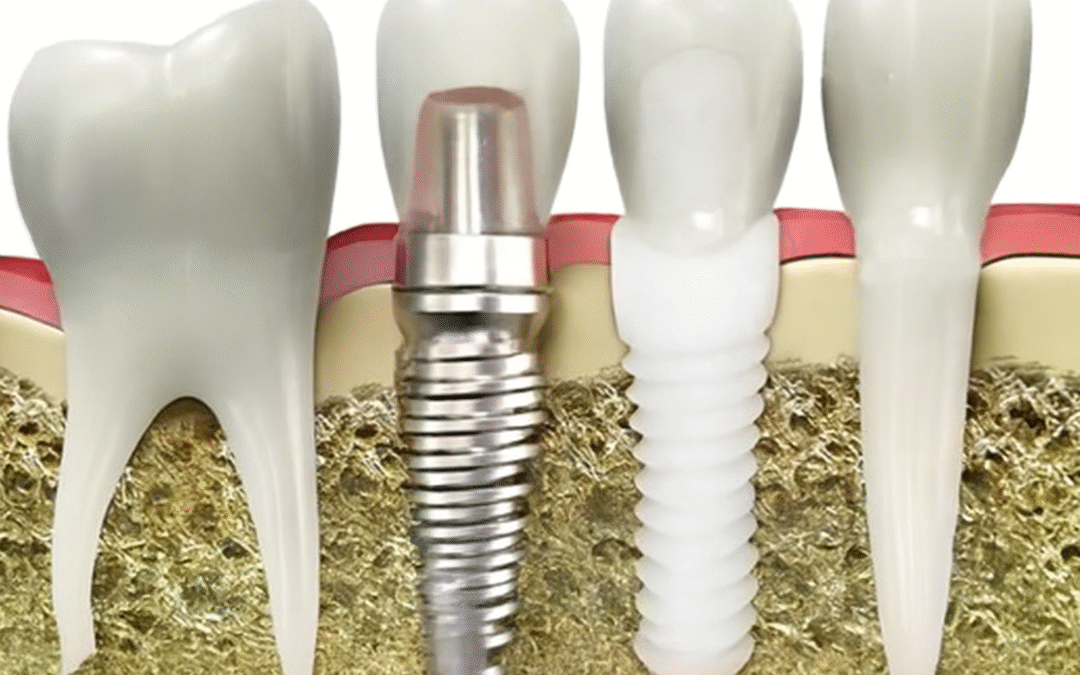 Dental Implant Materials