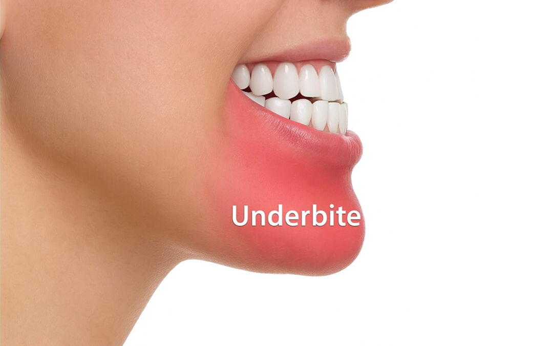 Underbite and Its Impact on Gum Health