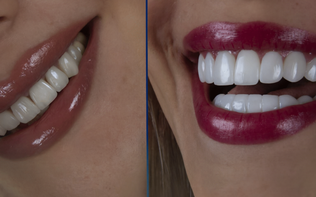 Dental Laminates or Veneers