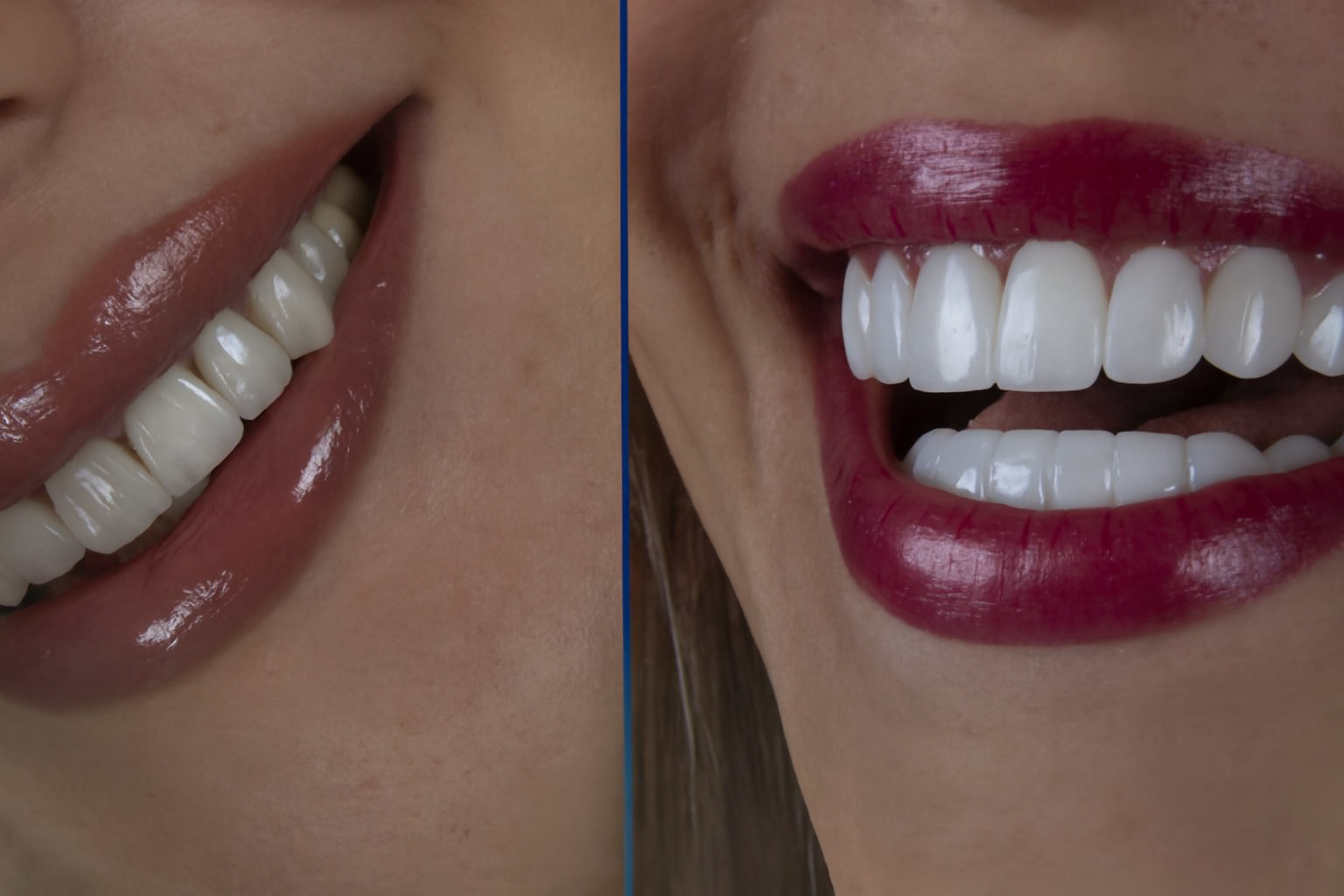 Dental Laminates or Veneers
