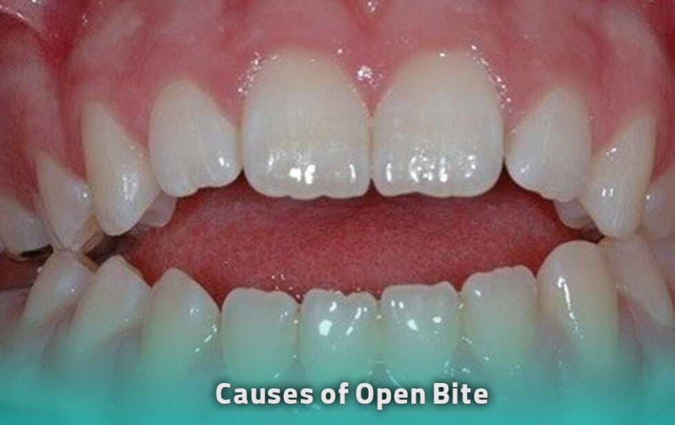 What Is An Open Bite And How Is It Treated What Is An Open Bite And How Is It Treated