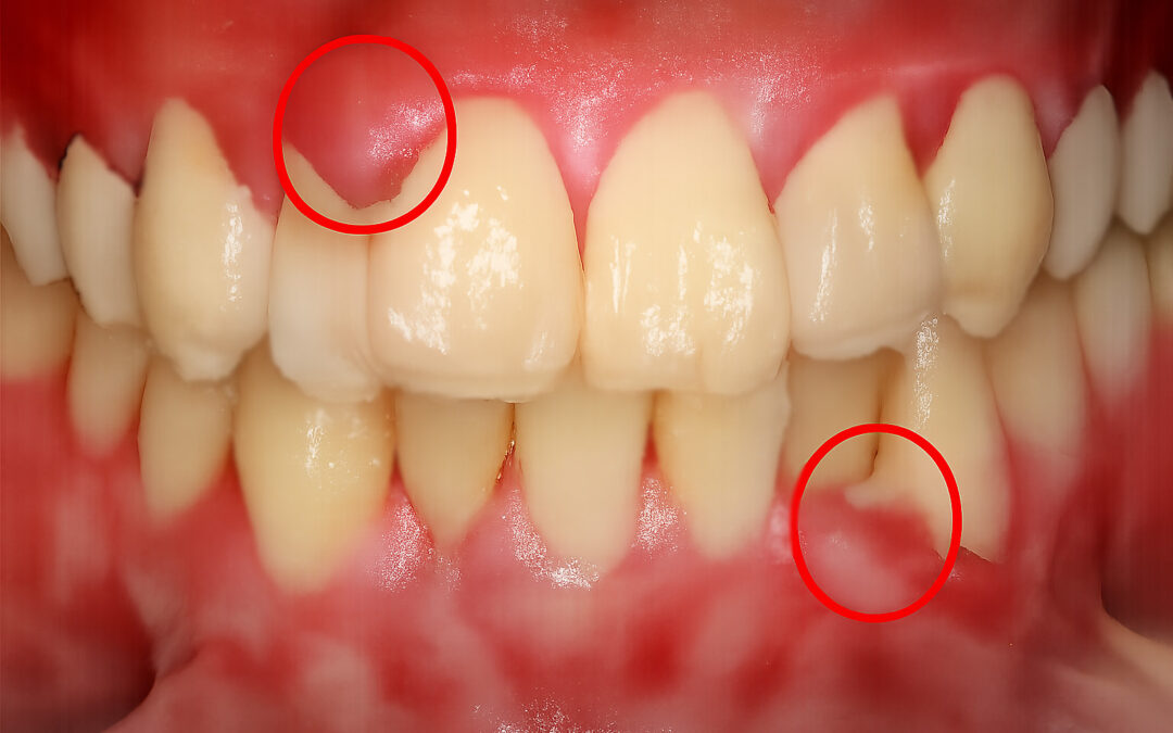 Common Tooth Diseases