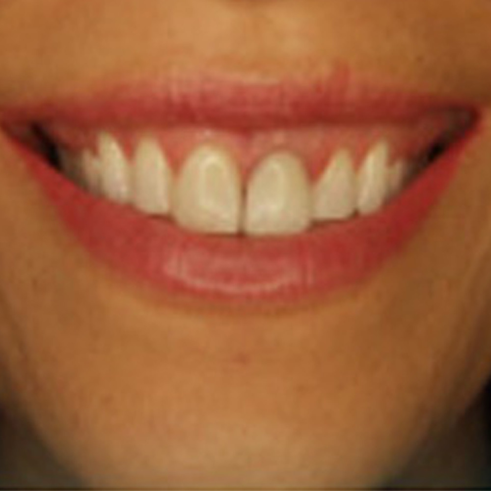 Gummy Smiles Treatment