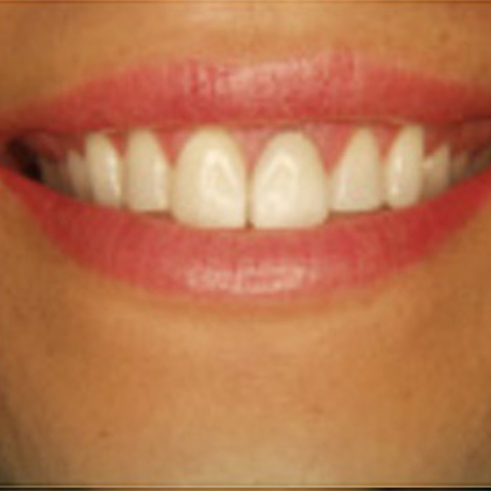 Gummy Smiles Treatment