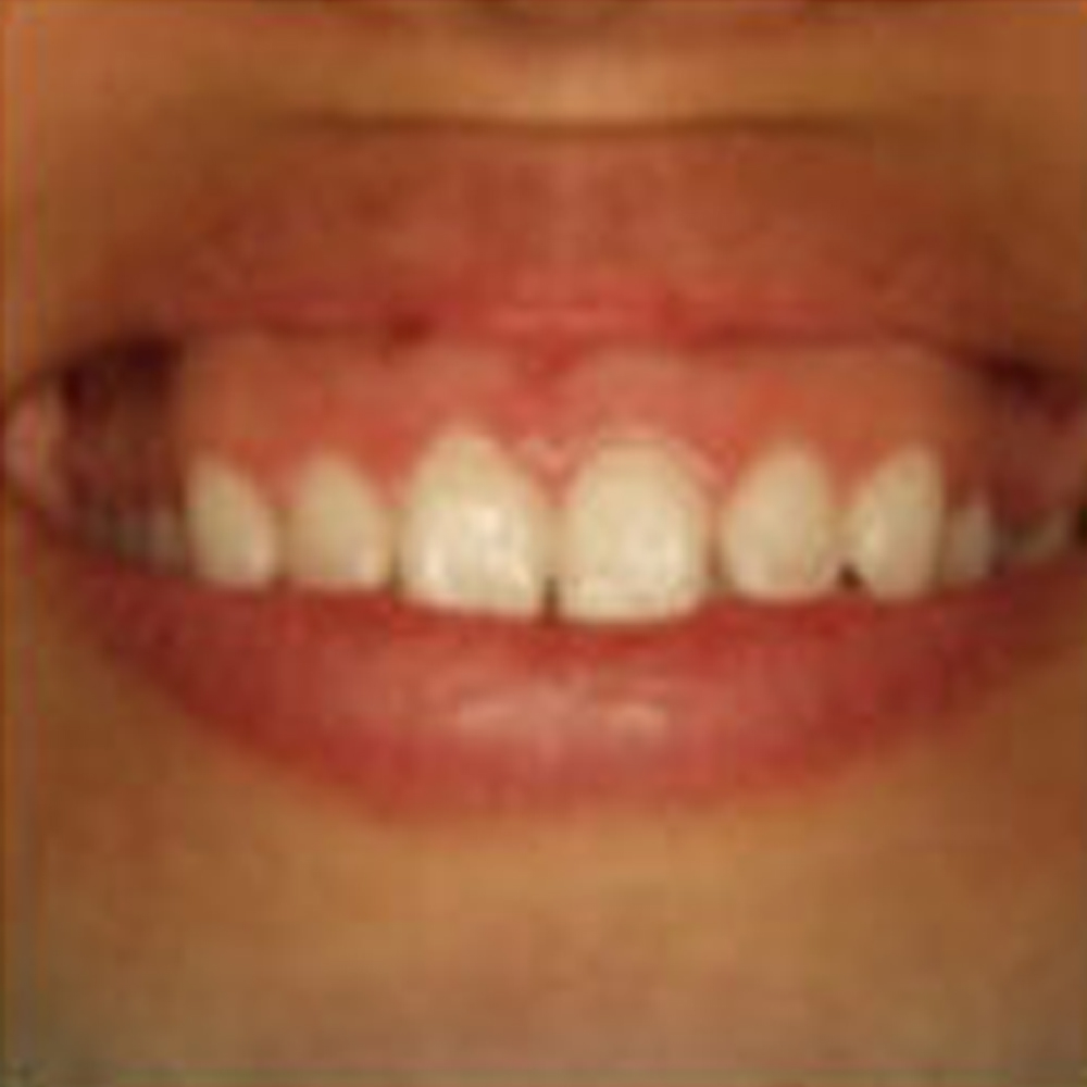 Gummy Smiles Treatment