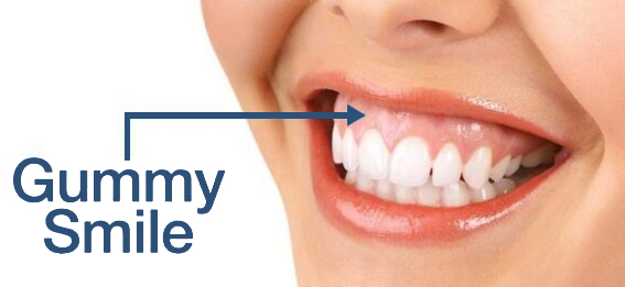Gummy Smiles Treatment
