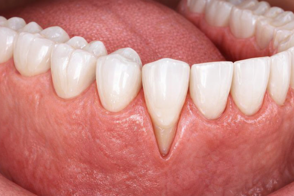 What Causes Gum Recession