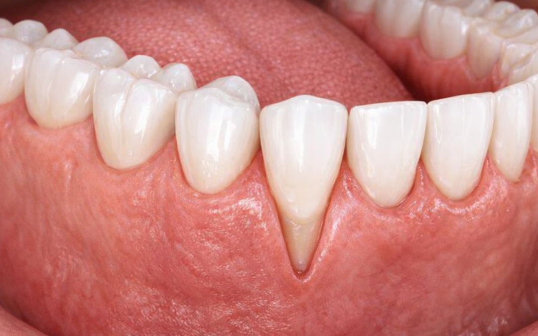 What Causes Gum Recession and How to Reverse It?